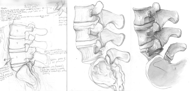 sketches of the lumbar region of the spine with a pars fracture at L5