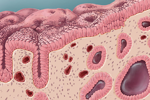 thumbnail image of a pathology illustration depicting endometrial hyperplasia