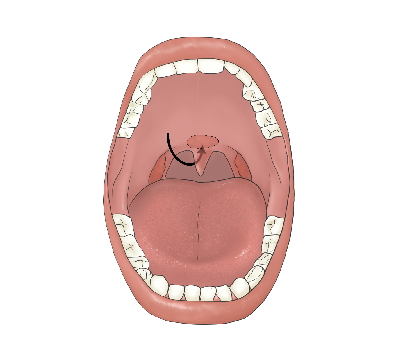 tonsils removed scabs