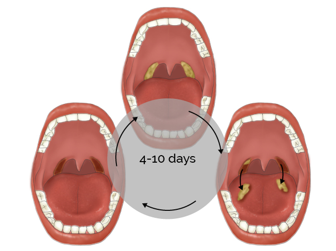 tonsils removed scabs