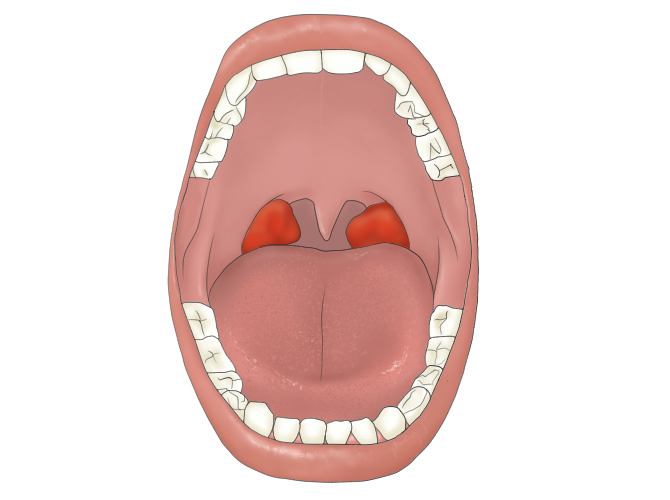 Swollen Tonsils